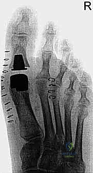 العلاج التحفظي وتعديل الأحذية لخشونة القدم