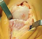 التشريح المعقد لمفصل إبهام القدم