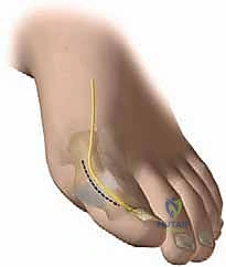 إبهام القدم المتيبس: الدليل الشامل لعلاج خشونة مفصل إبهام القدم الكبير مع الأستاذ الدكتور محمد هطيف في صنعاء