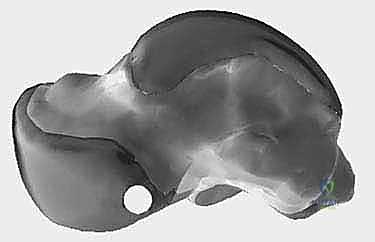 إيثاق ودمج مفصل إبهام القدم