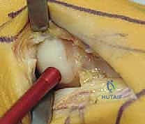 تنظيف المفصل وتحرير الأنسجة في عملية إبهام القدم