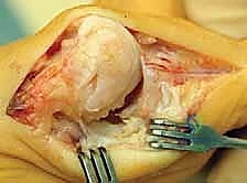 التصوير بالأشعة لتشخيص إبهام القدم المتيبس