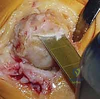 عملية استئصال النتوءات العظمية Cheilectomy