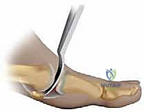 تقنية التثقيب المجهري Microfracture