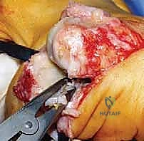 خطوات عملية استئصال النتوءات الظهرية خطوة بخطوة