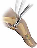 إعادة التأهيل بعد جراحة إبهام القدم المتيبس