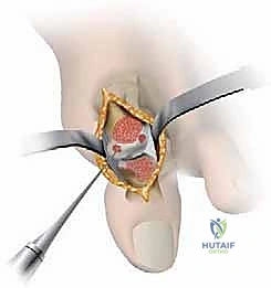 صورة توضيحية لـ إبهام القدم المتيبس: الدليل الشامل لعلاج خشونة مفصل إبهام القدم الكبير مع الأستاذ الدكتور محمد هطيف في صنعاء