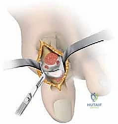 صورة توضيحية لـ إبهام القدم المتيبس: الدليل الشامل لعلاج خشونة مفصل إبهام القدم الكبير مع الأستاذ الدكتور محمد هطيف في صنعاء