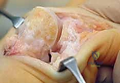 Illustration of extensive plantar release - Dr. Mohammed Hutaif