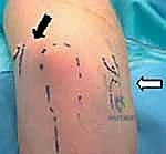 التصوير بالرنين المغناطيسي لتشخيص إصابات المرفق