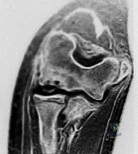 تشخيص داء بانر في مفصل المرفق للأطفال