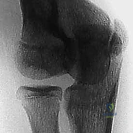 صورة توضيحية لـ تنظير المرفق والجراحة المصغرة لعلاج داء بانر والنخر العظمي الغضروفي في الكابيتيليوم