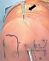 مراحل النخر العظمي الغضروفي في الكابيتيليوم