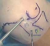 تنظير المرفق والجراحة المصغرة لعلاج داء بانر والنخر العظمي الغضروفي في الكابيتيليوم