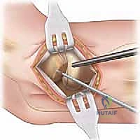 Illustration of panners disease and osteochondritis - Dr. Mohammed Hutaif
