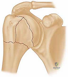 تشخيص كسور عظم العضد القريب بالأشعة المقطعية