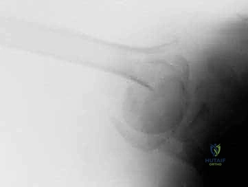 Illustration of hemiarthroplasty for proximal - Dr. Mohammed Hutaif