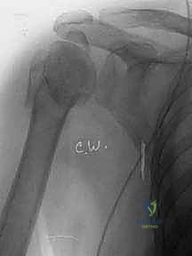 تشريح مفصل الكتف المعقد وعظم العضد القريب