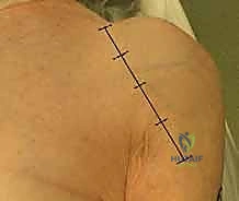 خطوات استخراج رأس العضد المتضرر