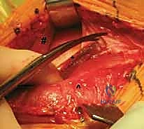 التخطيط الجراحي لعملية نصف مفصل الكتف