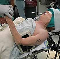 تجهيز القناة العظمية وزرع المفصل الصناعي