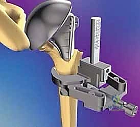 نصف مفصل الكتف لعلاج كسور عظم العضد القريب المعقدة دليل شامل من الأستاذ الدكتور محمد هطيف