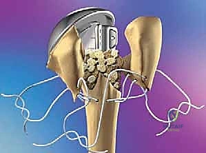 صورة توضيحية لـ نصف مفصل الكتف لعلاج كسور عظم العضد القريب المعقدة دليل شامل من الأستاذ الدكتور محمد هطيف