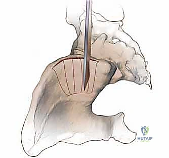 إتقان زراعة العظم من حرقفة الحوض: دليل شامل للمرضى مع الأستاذ الدكتور محمد هطيف