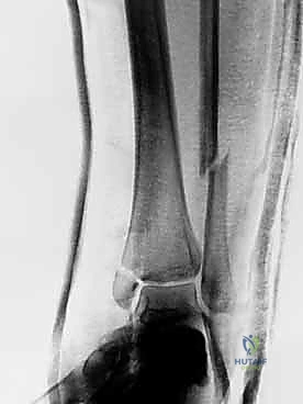 الإصابات الرياضية وتأثيرها على الكاحل