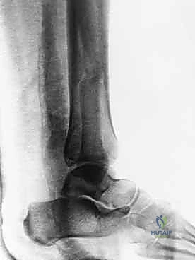 تأثير الكسر على توزيع الوزن