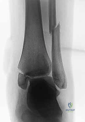الجبس الطبي كعلاج تحفظي