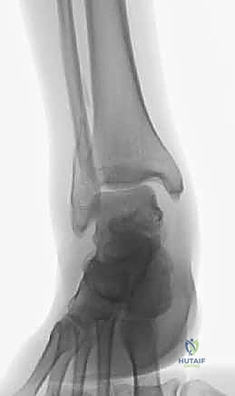 تورم وكدمات الكاحل بعد الكسر