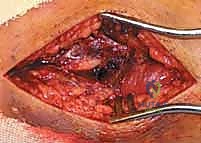 استعادة مفصل الكاحل بعد الكسر: دليل شامل لمرضى كسور الكاحل ثنائية الكعب