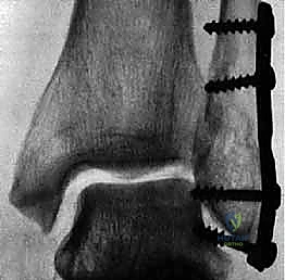 استخدام تقنية المنظار 4K للتقييم