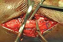 إغلاق الجرح بتقنيات التجميل الدقيقة