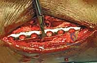 أدوات التثبيت الداخلي المستخدمة