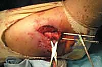 صورة توضيحية لـ استعادة مفصل الكاحل بعد الكسر: دليل شامل لمرضى كسور الكاحل ثنائية الكعب