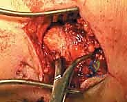 تثبيت الكعب الإنسي بالمسامير