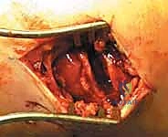 صورة توضيحية لـ استعادة مفصل الكاحل بعد الكسر: دليل شامل لمرضى كسور الكاحل ثنائية الكعب