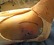 صورة توضيحية لـ استعادة مفصل الكاحل بعد الكسر: دليل شامل لمرضى كسور الكاحل ثنائية الكعب