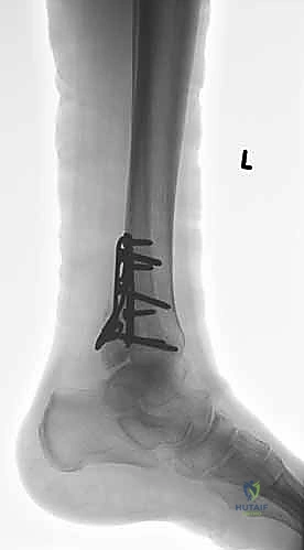 صورة توضيحية لـ استعادة مفصل الكاحل بعد الكسر: دليل شامل لمرضى كسور الكاحل ثنائية الكعب
