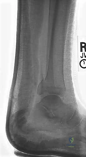 صورة طبية: استعادة مفصل الكاحل بعد الكسر: دليل شامل لمرضى كسور الكاحل ثنائية الكعب