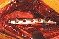 صورة توضيحية لـ استعادة مفصل الكاحل بعد الكسر: دليل شامل لمرضى كسور الكاحل ثنائية الكعب