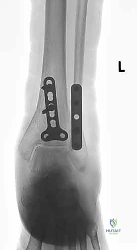 الشق الجراحي الدقيق للكعب الوحشي
