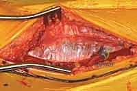 صورة طبية: استعادة مفصل الكاحل بعد الكسر: دليل شامل لمرضى كسور الكاحل ثنائية الكعب