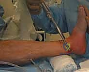 صورة توضيحية لـ استعادة مفصل الكاحل بعد الكسر: دليل شامل لمرضى كسور الكاحل ثنائية الكعب