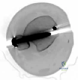 Ankle Mortise Restoration: An Intraoperative Masterclass in Bimalleolar ORIF
