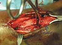 فقدان استقرار مفصل الكاحل بعد الإصابة