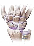 صورة توضيحية لـ علاج عدم التئام العظم الزورقي بالرسغ: ترقيع العظم وتثبيت داخلي مع الأستاذ الدكتور محمد هطيف