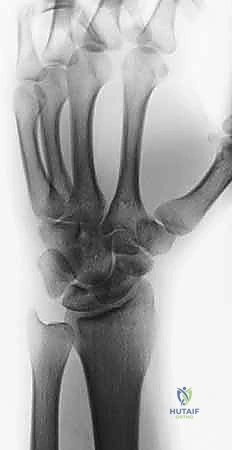 صورة توضيحية للتشريح المعقد للعظم الزورقي في الرسغ والتروية الدموية